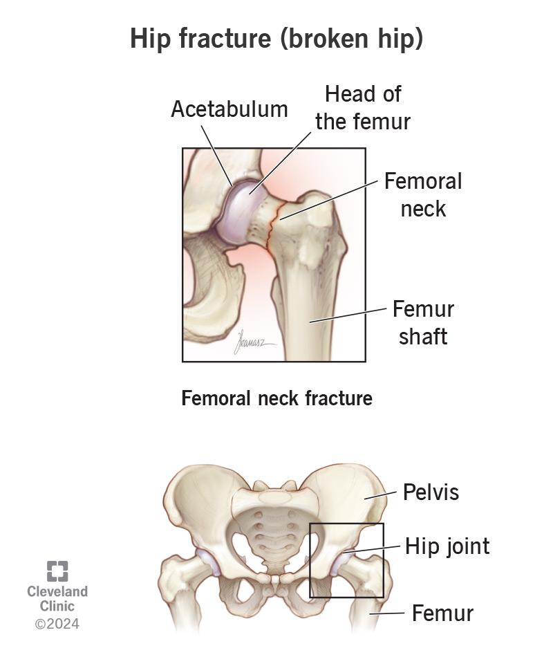 Hip Fracture in the Elderly: A Critical Challenge to Independence and Quality of Life