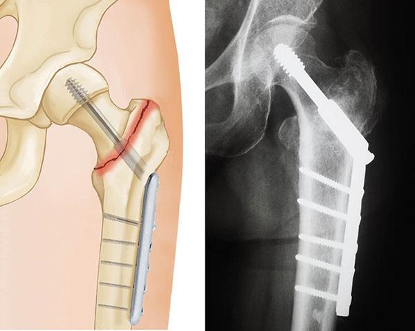 Hip Fracture in the Elderly: Causes, Consequences, Prevention, and the Role of Smart Elderly Care